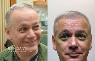 hair transplantation clinic cary Koher Hair Transplants