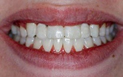 teeth whitening service fayetteville Ascot Aesthetic Implants & Dentistry