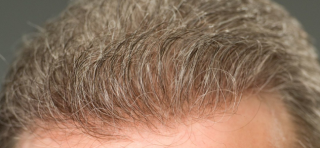 The permanent hair replacement that does not require service visits